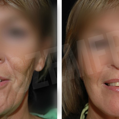 facelift3_e1611988802687_607e199a3cfc1.jpg