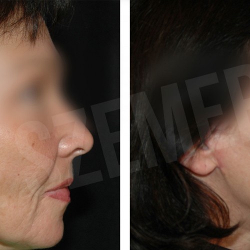 facelift6_e1611988742183_607e199b2029c.jpg