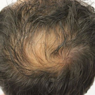 haartransplantation10_607dca3ecf1c5.jpg