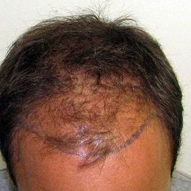 haartransplantation12_607dca3eeff71.jpg