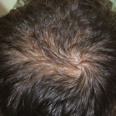 haartransplantation9_607dca3edf51d.jpg